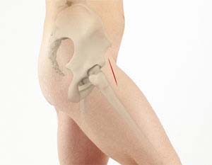 Posterior Approach Hip Replacement